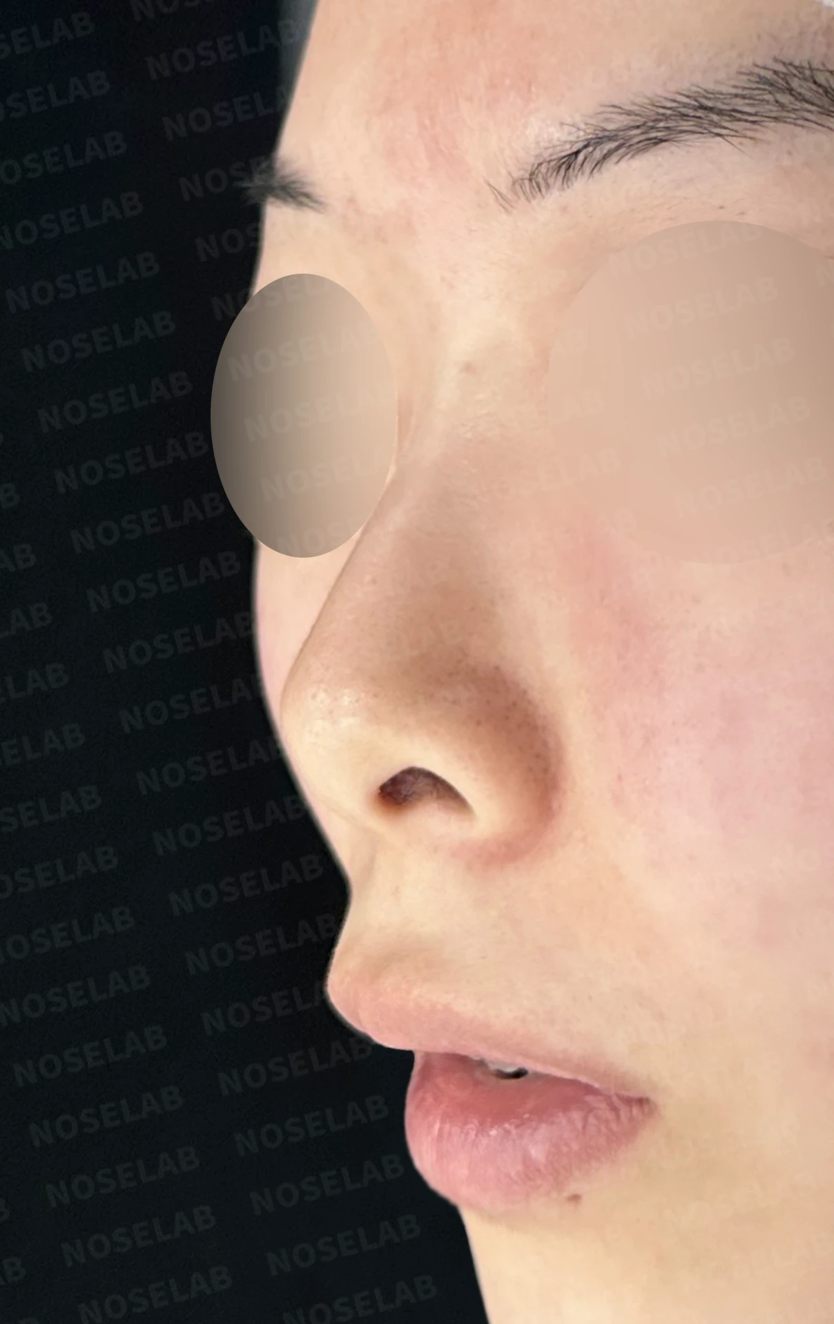 작고 낮은 코, 자가늑연골로 비순각 교정까지 한 번에 완성한 비개방 코성형 — 전(좌) 직후(후)