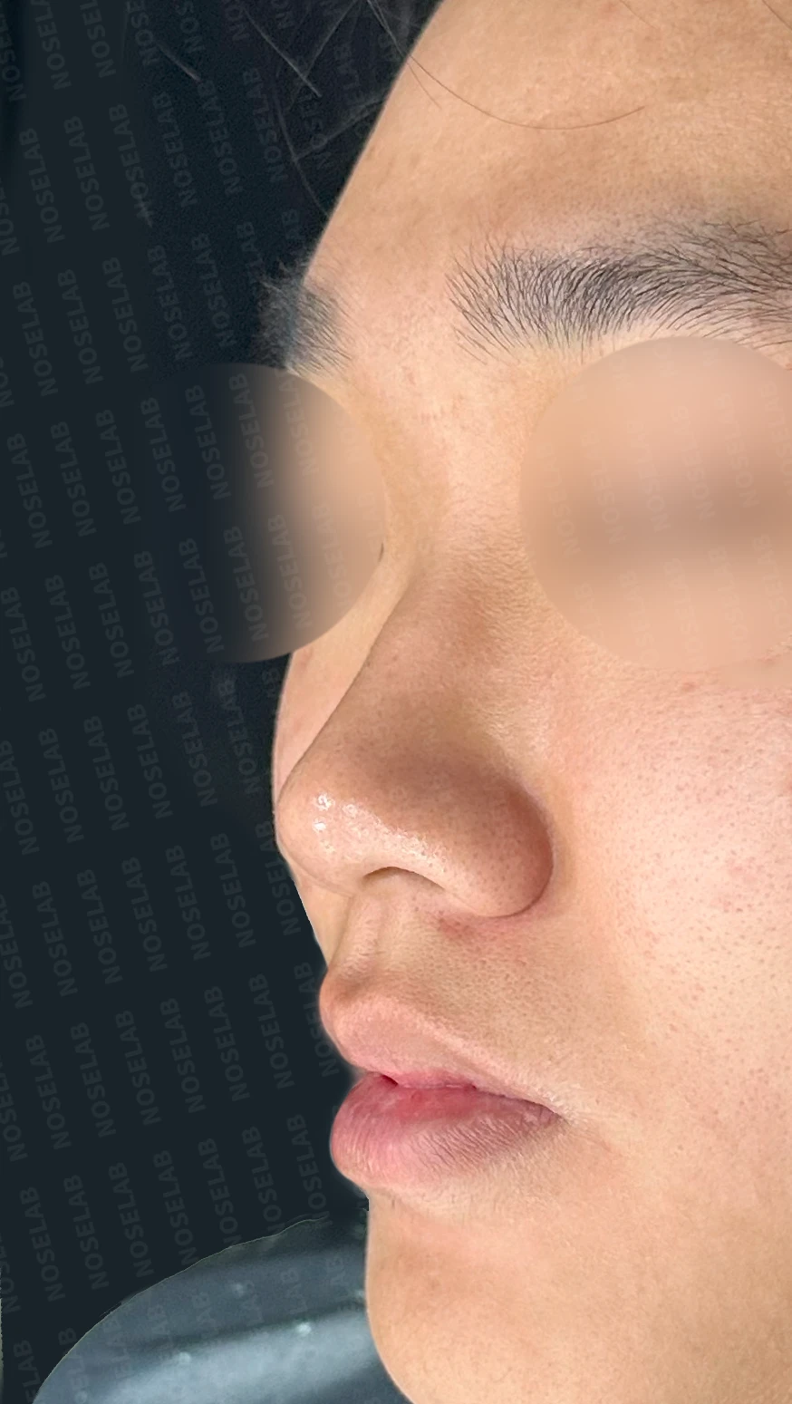 낮은 코와 코막힘을 함께 살펴보는 교정 방법 — 수술 전 / 수술 직후 0일 직후 사진은 부기가 있는 상태로 최종 결과와 다를 수 있습니다.