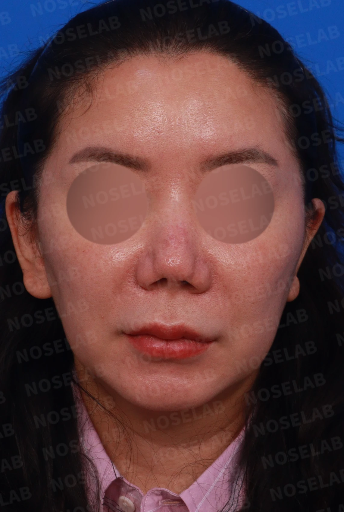 코끝이 찝히고 비주가 함몰되는 이유, 메드포어 제거와 재건은 어떻게 하나 — 디자인 상담 정면, 좌측 측면, 비스듬한 측면 사진
