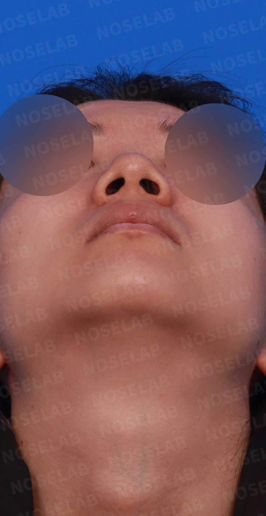 코 필러를 녹이지 않은 채 코가 퍼져 보이는 이유, 얄쌍한 라인을 만드는 방법 — 디자인 상담 우측 비스듬한 측면, 측면, 비공 사진