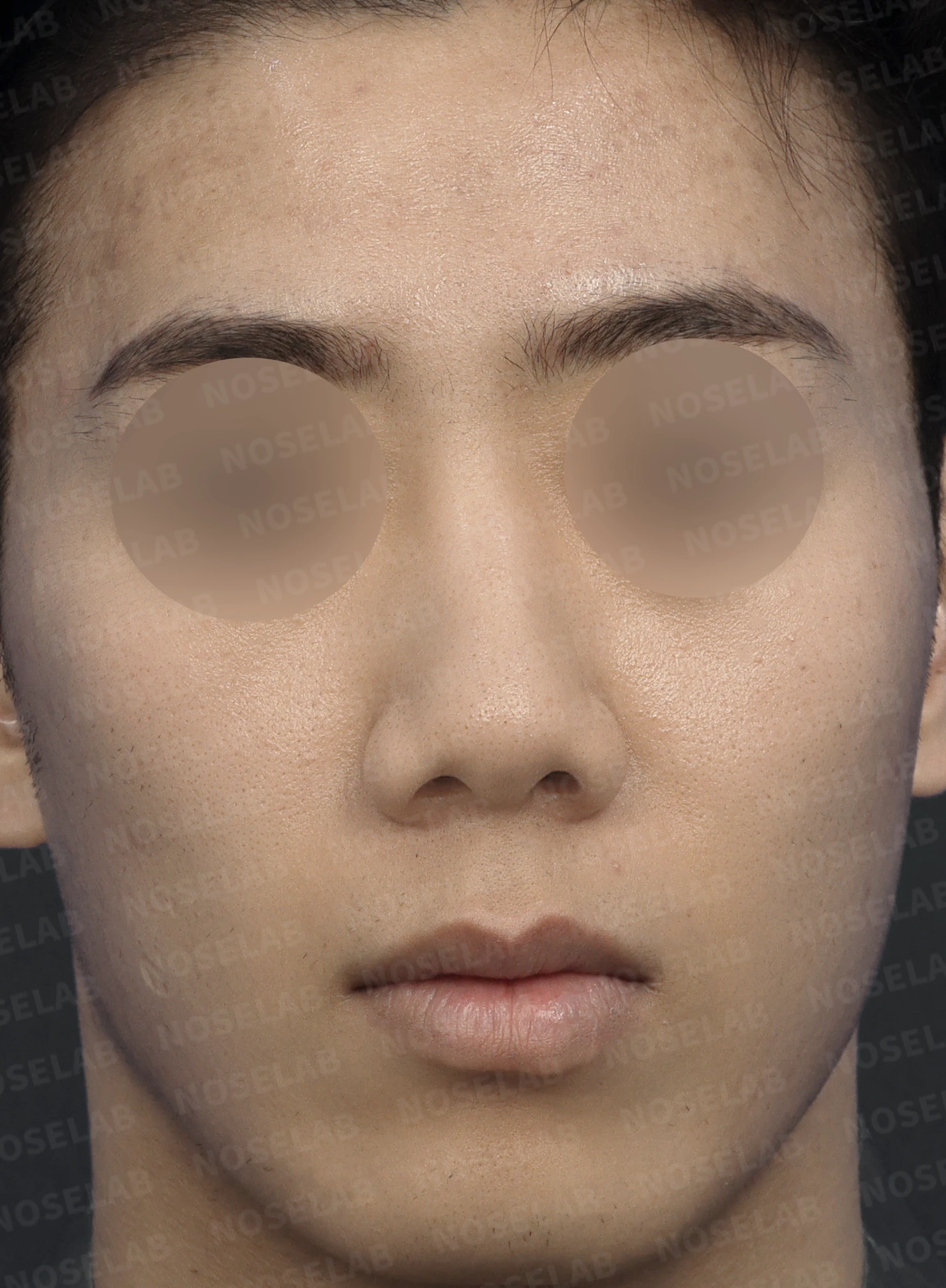 복코 교정과 비주 내리기를 함께 계획하는 방법 — 수술 전 / 수술 직후 0일 직후 사진은 부기가 있는 상태로 최종 결과와 다를 수 있습니다.