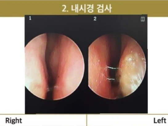 보형물을 제거한 뒤 콧대가 꺼지고 퍼지는 이유, 재건은 어떻게 하나 — 코 내시경 사진