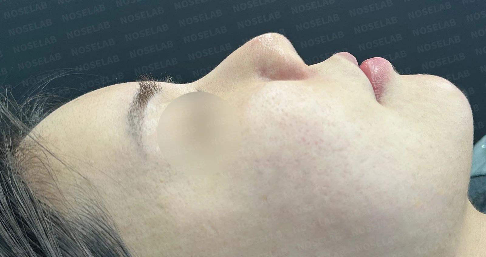 복코 교정과 비주 내리기 방법 — 수술 전 / 수술 직후 0일 직후 사진은 부기가 있는 상태로 최종 결과와 다를 수 있습니다.