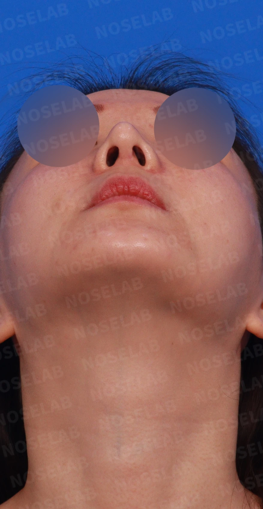 코가 휘어 보이고 비주가 한쪽으로 기우는 이유, 교정은 어떻게 하나 — 디자인 상담 우측 측면, 비스듬한 측면 비공 사진