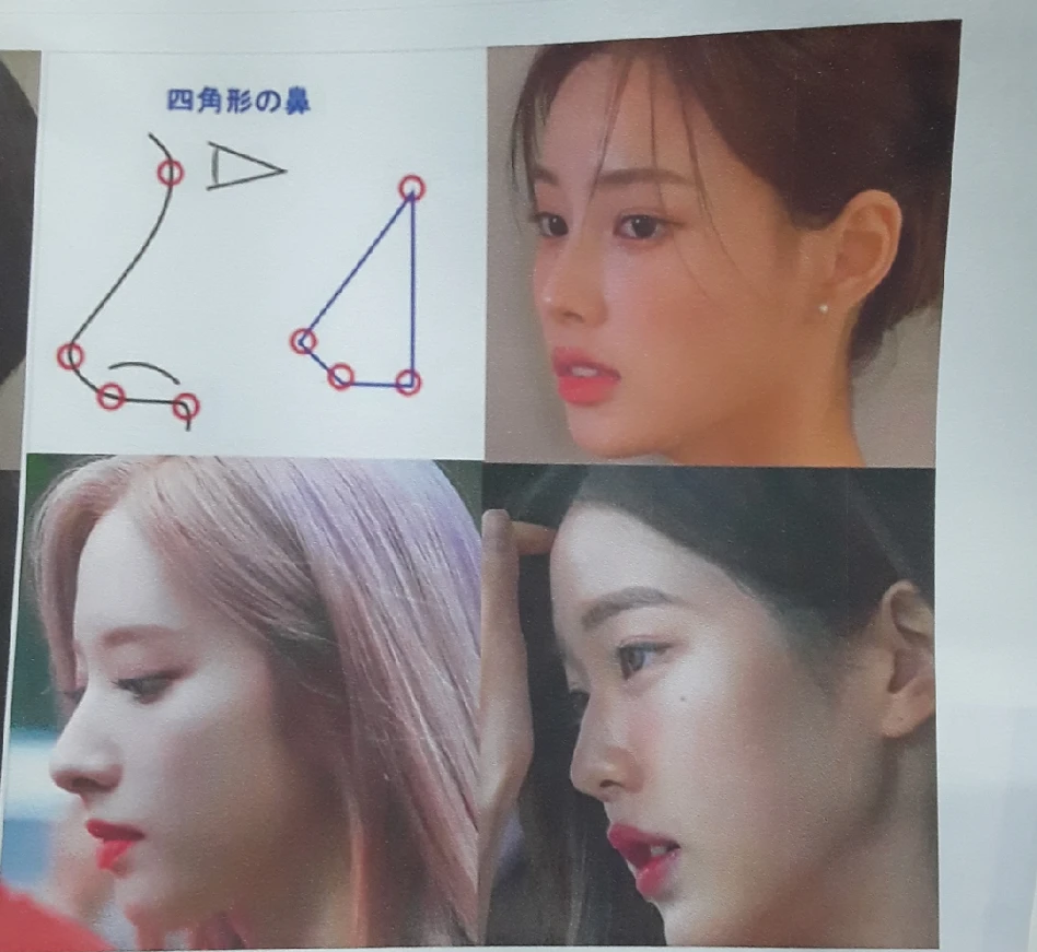 두꺼운 비주와 들린 코끝이 생기는 이유, 자가 늑연골 재건은 어떻게 하나 — 본문 사진 2