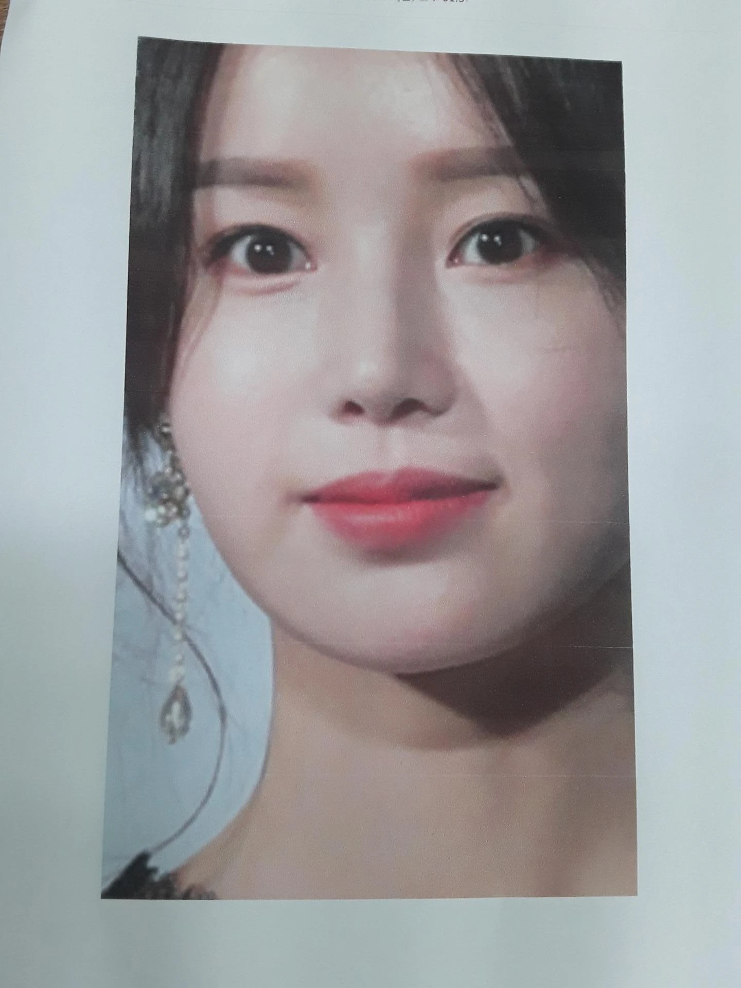 코가 들리고 콧기둥이 꺼지며 코끝이 찝혀 보이는 이유, 복합 교정은 어떻게 하나 — 본문 사진 8