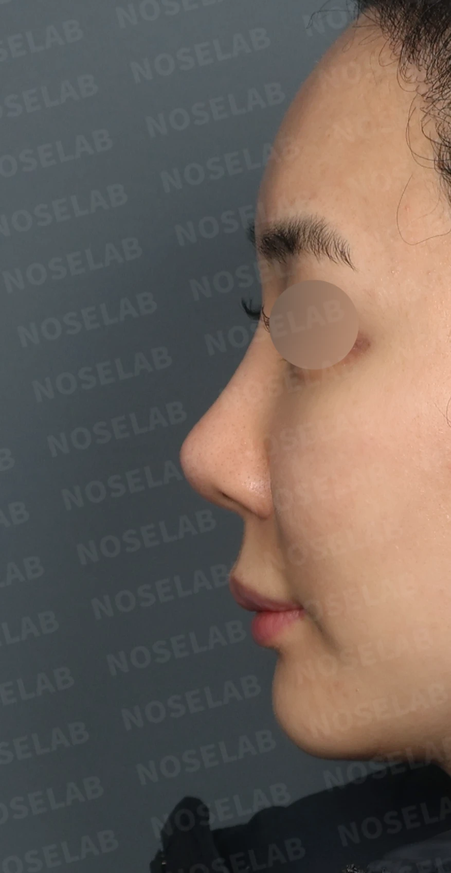 L자 보형물 제거 후 자가 늑연골로 코끝을 교정한 코재수술 — 디자인 상담 정면, 좌측 측면, 비스듬한 측면 사진