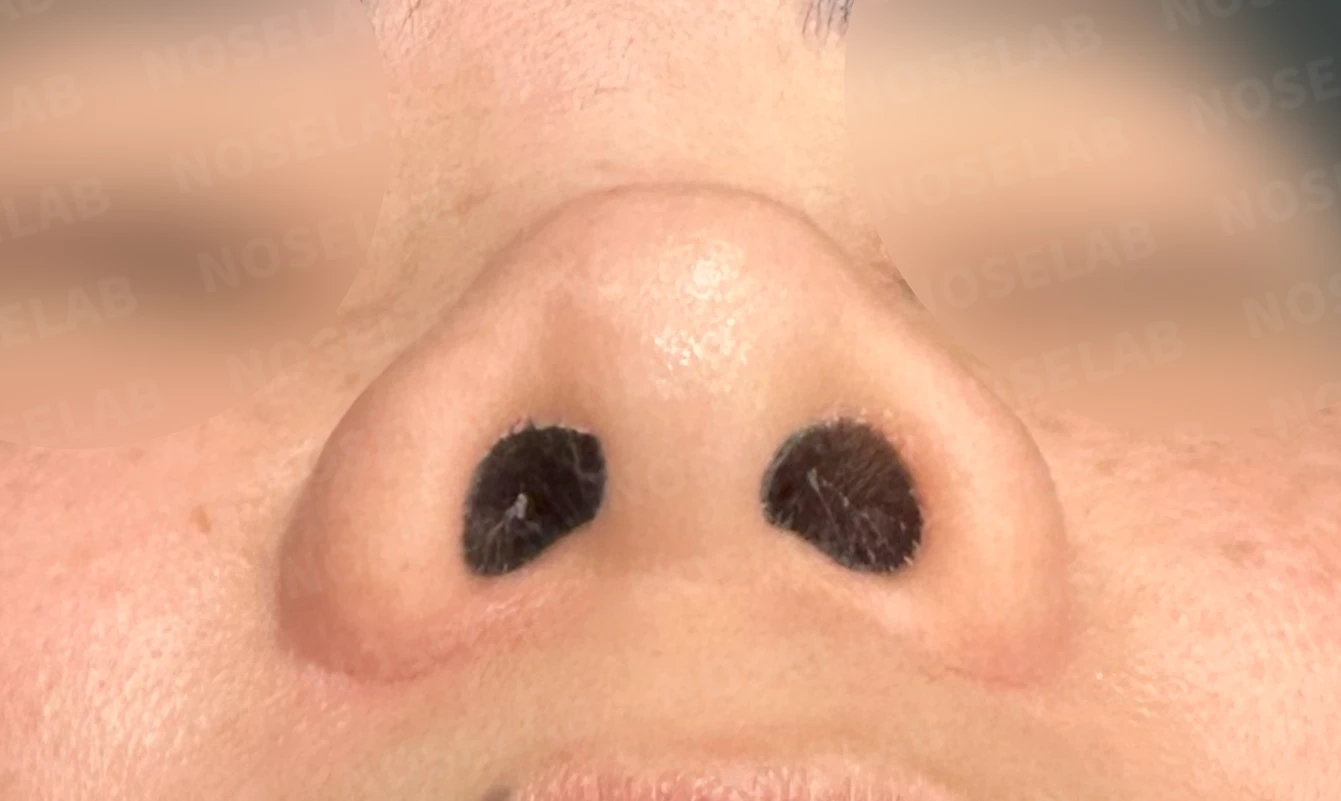 콧대가 평행선처럼 보이는 조건과 콧구멍 모양을 정하는 기준 — 수술 전 / 수술 직후 0일 직후 사진은 부기가 있는 상태로 최종 결과와 다를 수 있습니다.