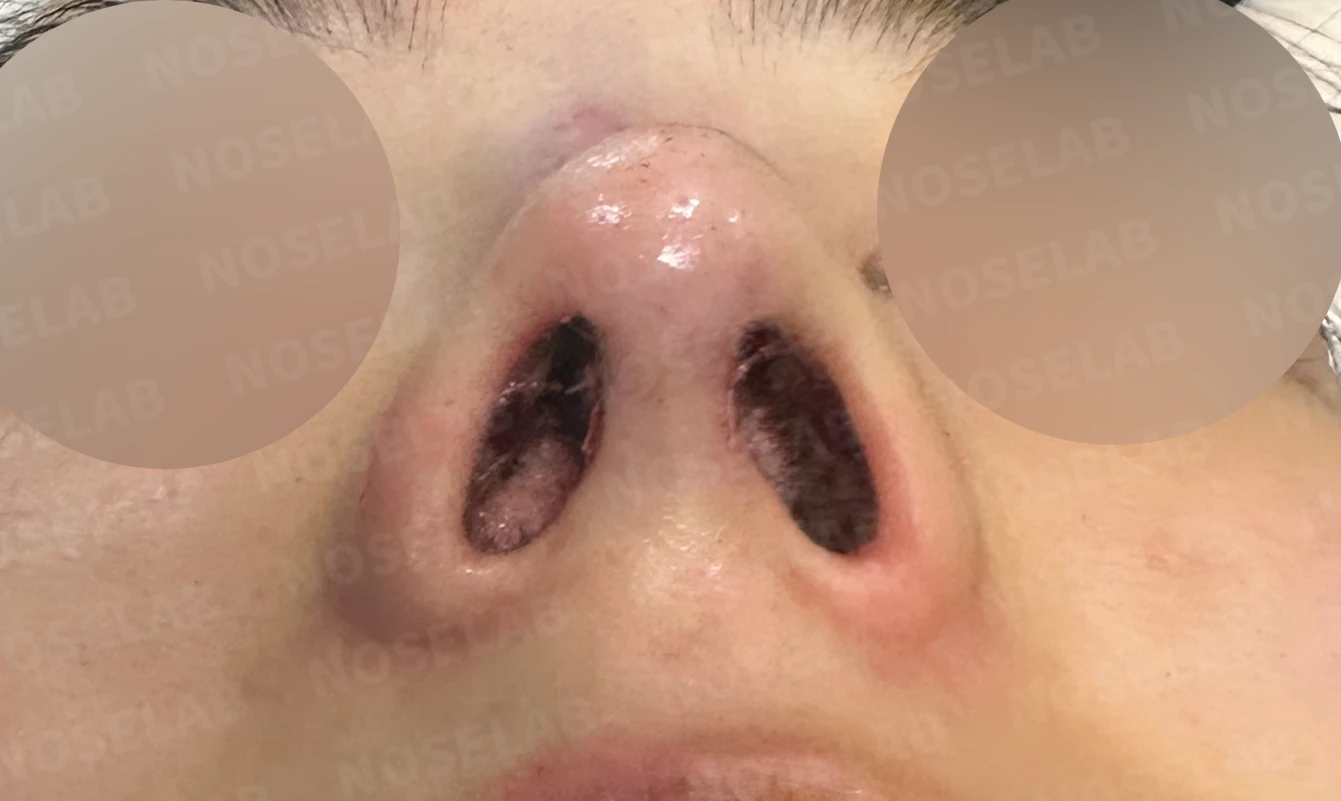 여러 차례 받은 코필러가 남긴 퍼진 코와 코막힘, 어떻게 정리하나 — 수술 직후 0일 비공 사진 직후 사진은 부기가 있는 상태로 최종 결과와 다를 수 있습니다.