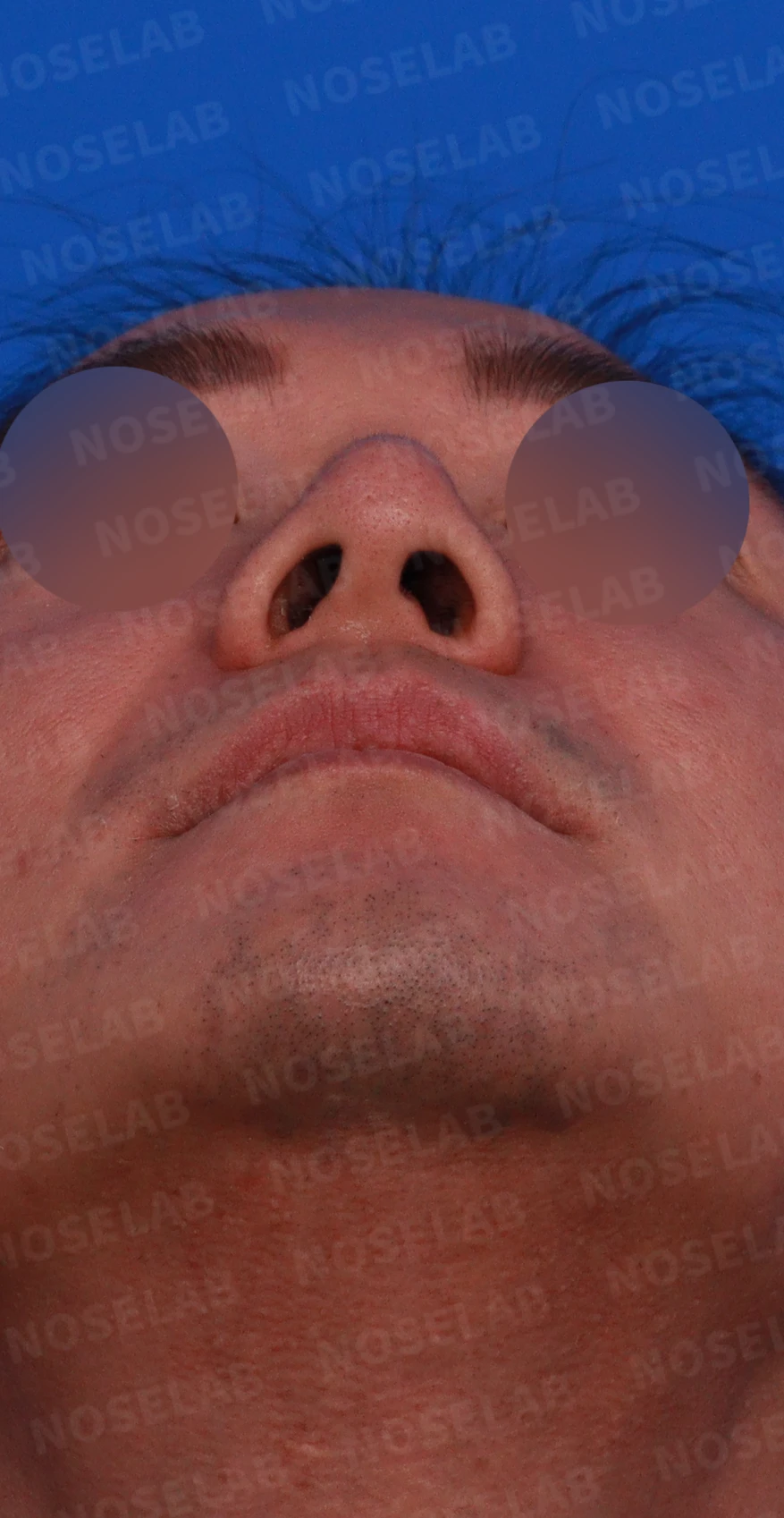 휜코와 코막힘, 코끝 구조를 함께 교정하는 방법 — 디자인 상담 우측 측면, 비스듬한 측면, 비공 사진입니다.