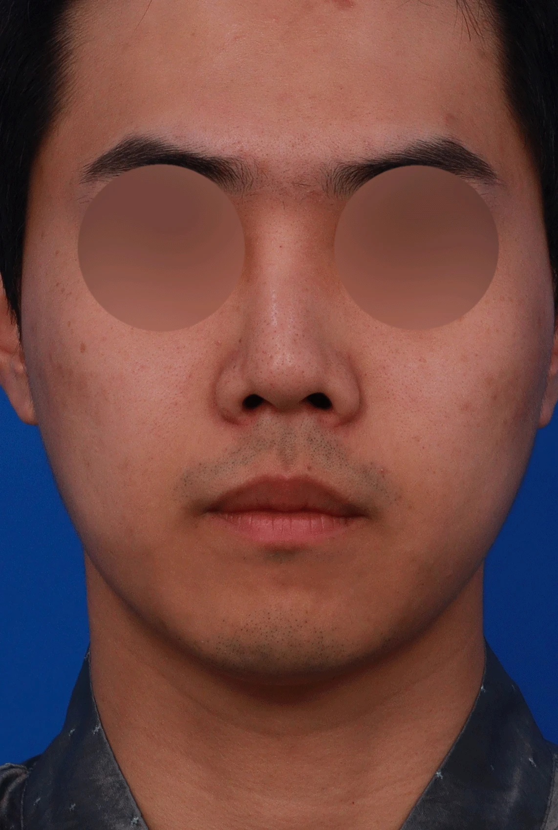 휜 코와 비공 노출 개선 - 자연스러운 코끝 상승 사례 — 디자인 상담 정면, 좌측 측면, 비스듬한 측면 사진입니다.