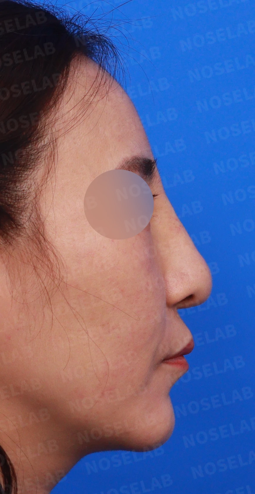 무자격 불법 주사 뒤 콧구멍이 좁아지는 이유와 제거·재건 방법 — 디자인 상담 우측 비스듬한 측면, 측면, 비공 사진입니다.