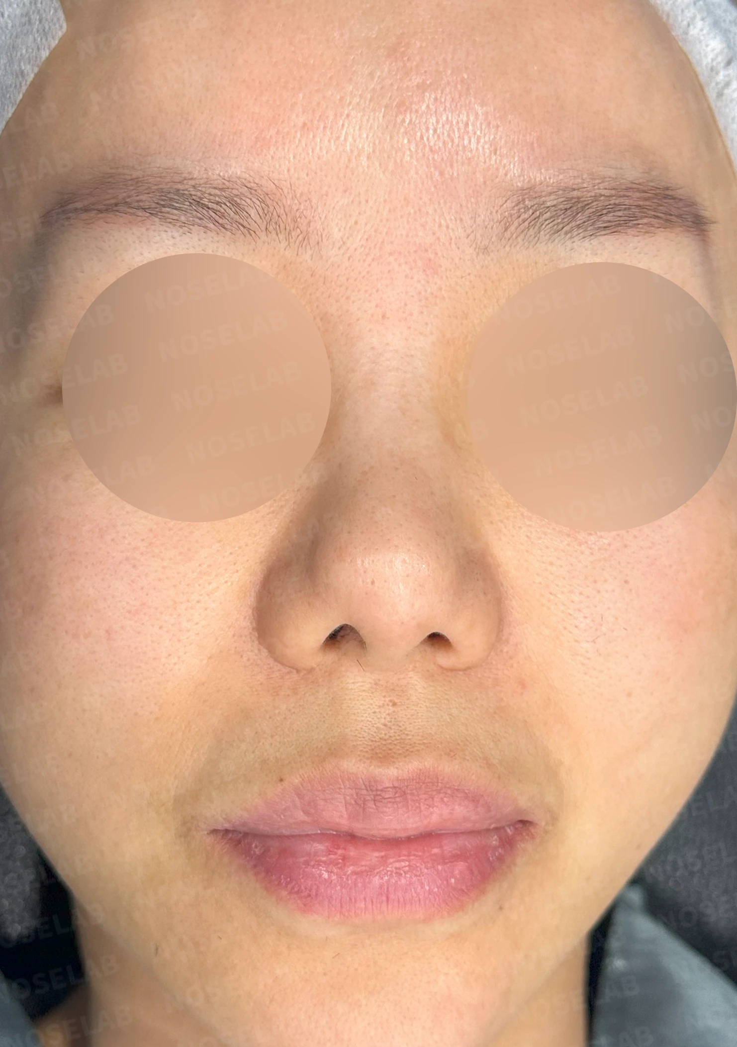보형물을 제거한 뒤 콧대가 꺼지고 퍼지는 이유, 재건은 어떻게 하나 — 수술 전 / 수술 직후 0일 직후 사진은 부기가 있는 상태로 최종 결과와 다를 수 있습니다.