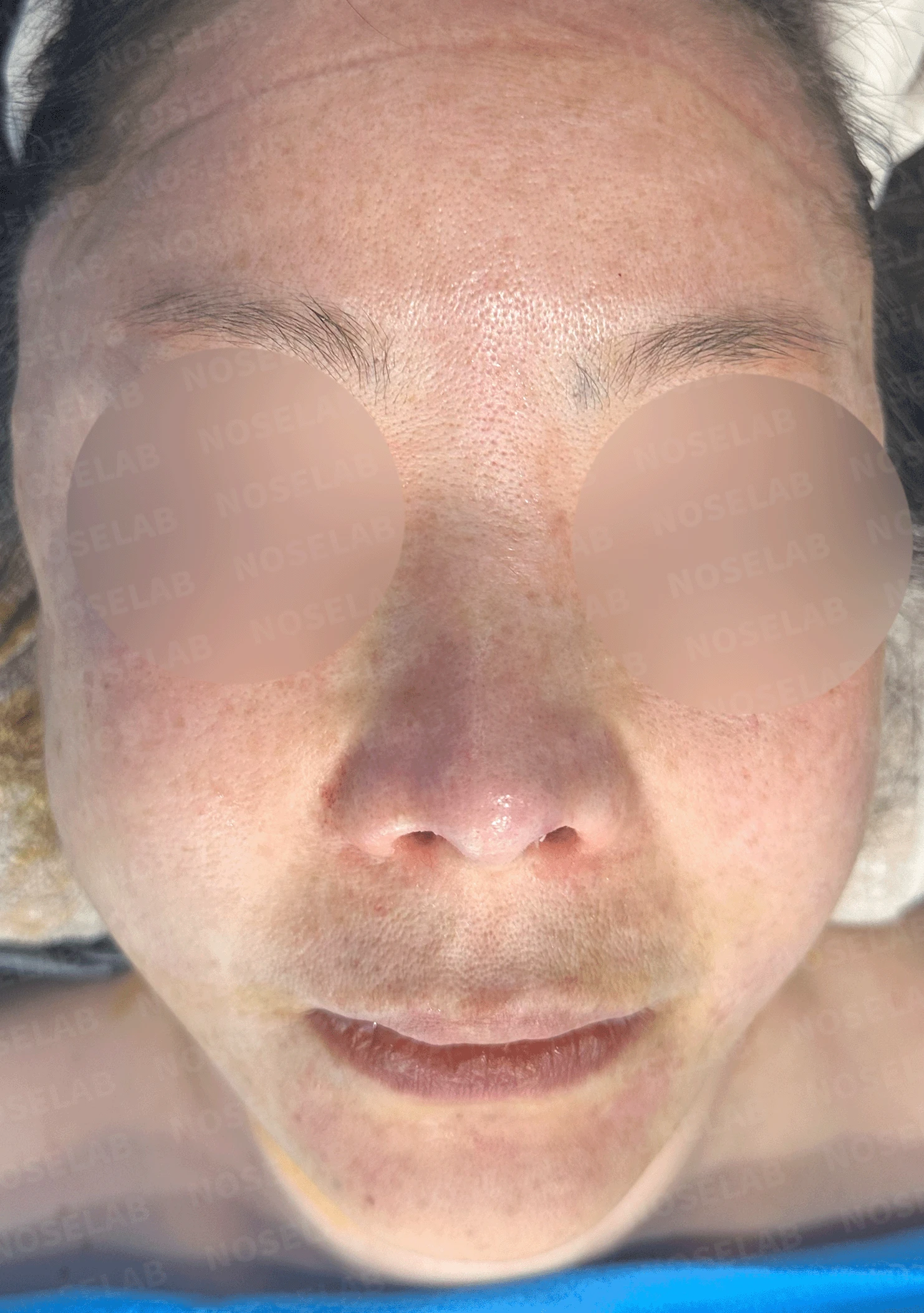 코가 짧고 들리며 비주가 함몰되는 이유, 자가 늑연골 재건은 어떻게 하나 — 본문 사진 9