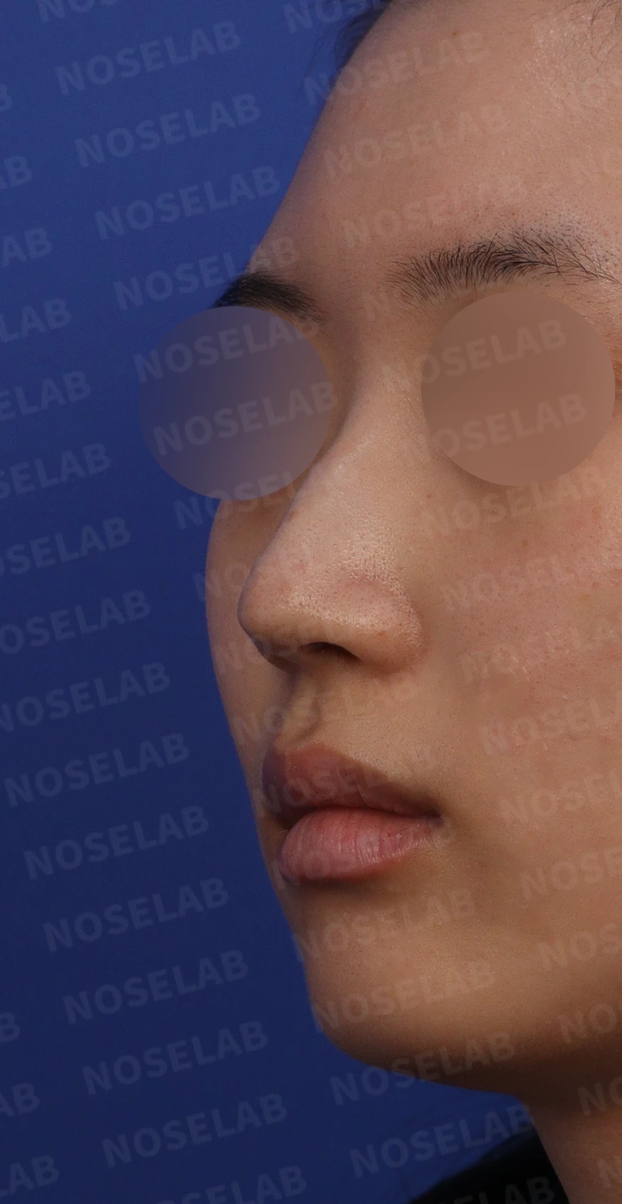 매부리코에 코의 휨과 비공 비대칭이 함께 오는 이유, 비중격 연골 교정은 어떻게 하나 — 디자인 상담 정면, 좌측 측면, 비스듬한 측면 사진