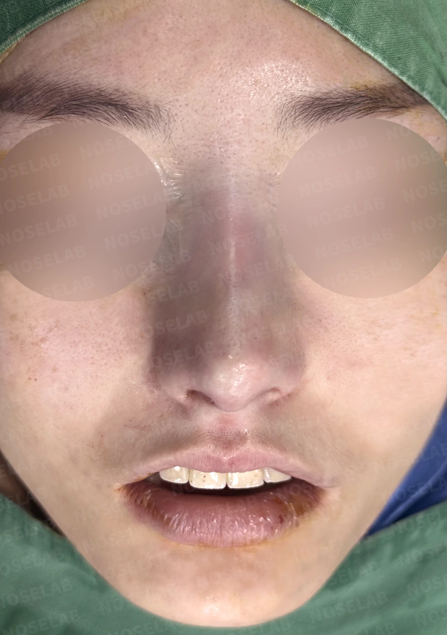 매부리코 교정, 자가늑연골로 자연스러운 코 라인 완성 — 직후 정면, 비스듬한 측면, 측면 사진입니다.