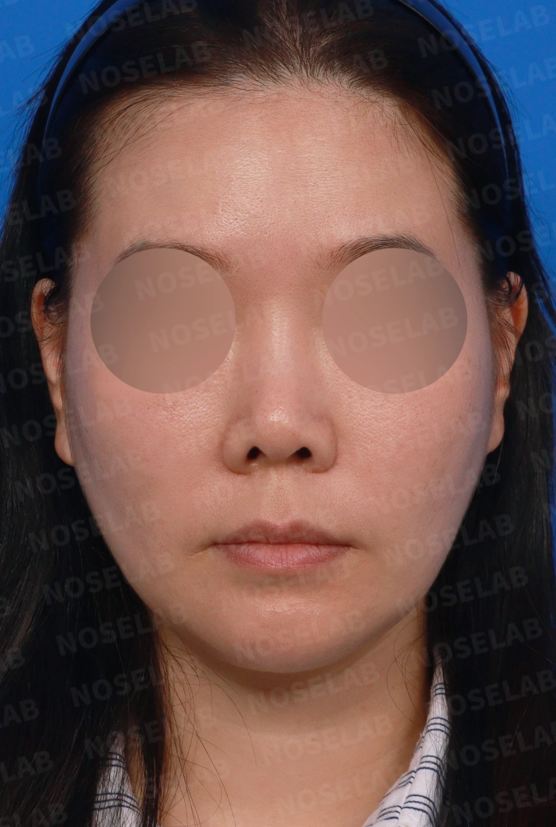 오래된 코성형 뒤 코끝이 들리고 콧구멍이 드러나는 이유, 제거와 자가진피 재건은 어떻게 하나 — 디자인 상담 정면, 좌측 측면, 비스듬한 측면 사진