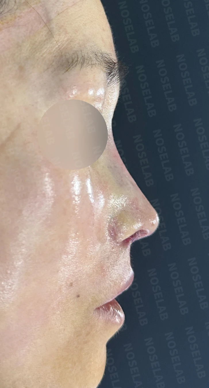 인중축소술 교정과 자가진피 제거 가능한가요? — 수술 직후 0일 사진 90도, 45도, 정면 직후 사진은 부기가 있는 상태로 최종 결과와 다를 수 있습니다.