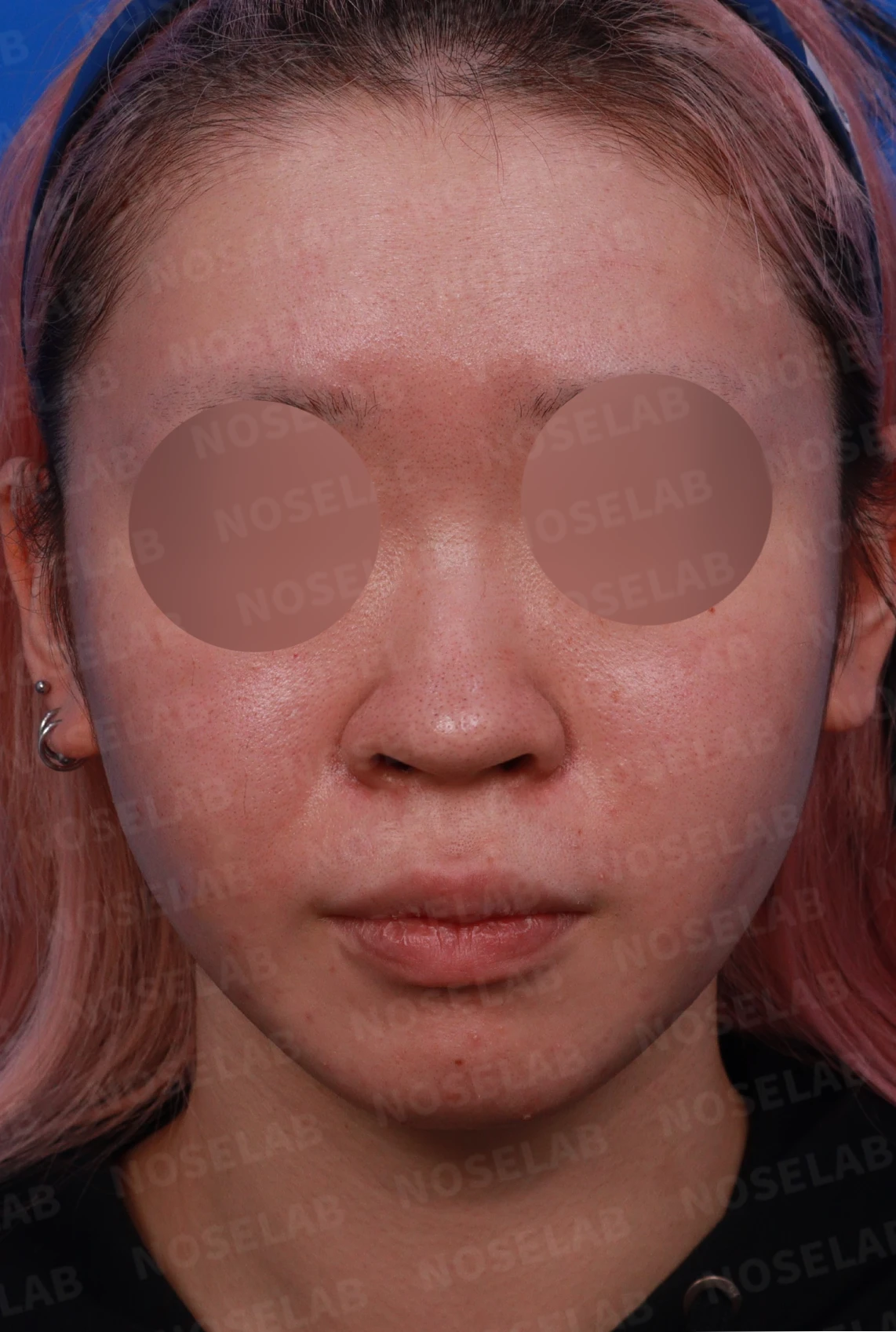 퍼진코, 복코 교정으로 균형 잡힌 이미지 완성 — 디자인 상담 정면, 우측 비스듬한 측면, 측면 사진입니다.