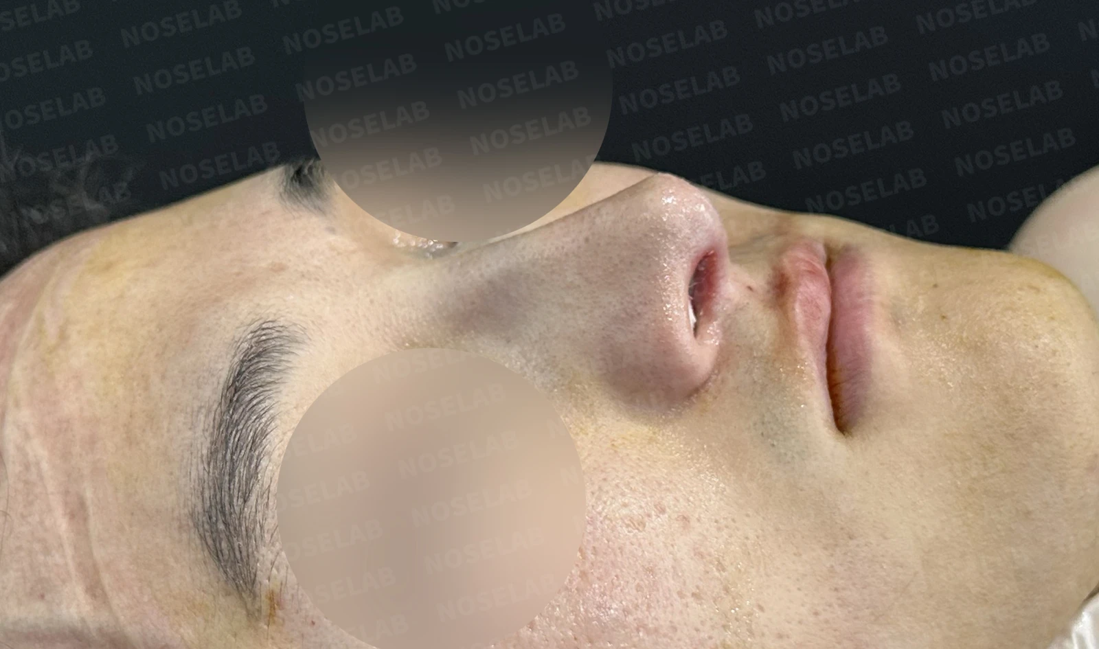 휜코 교정하면 안면 비대칭이 좋아질까요? — 수술 전 / 수술 직후 0일 직후 사진은 부기가 있는 상태로 최종 결과와 다를 수 있습니다.
