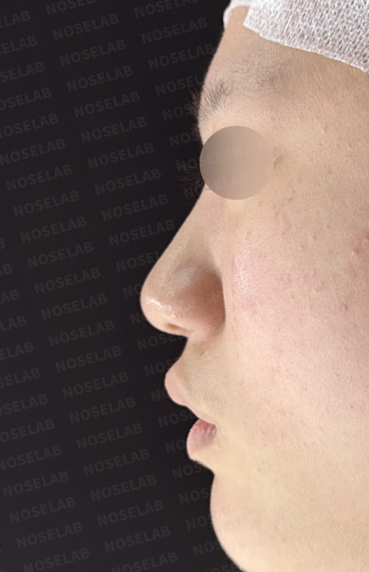 뭉툭한 코끝과 퍼진 코, 자가늑연골 비중격 연장술로 자연스럽게 교정 — 전(좌) 직후(후)
