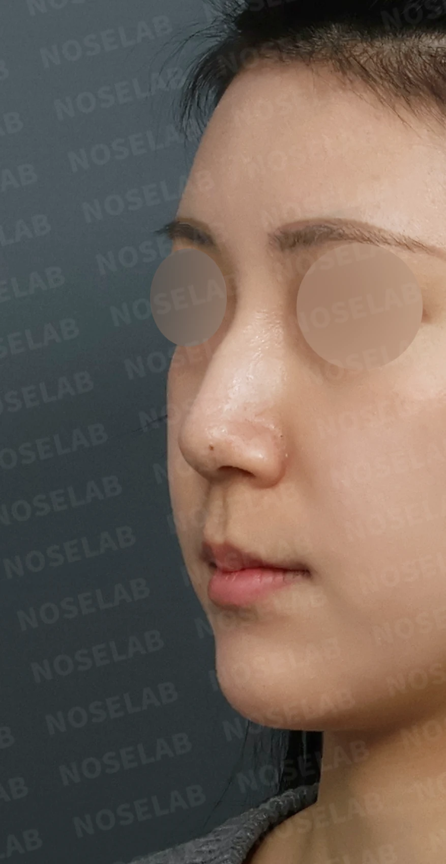 코필러 제거 후 자가늑연골 코성형, 처진 코끝과 메부리코를 자연스럽게 교정 — 디자인 상담 정면, 좌측 측면, 비스듬한 측면 사진입니다.
