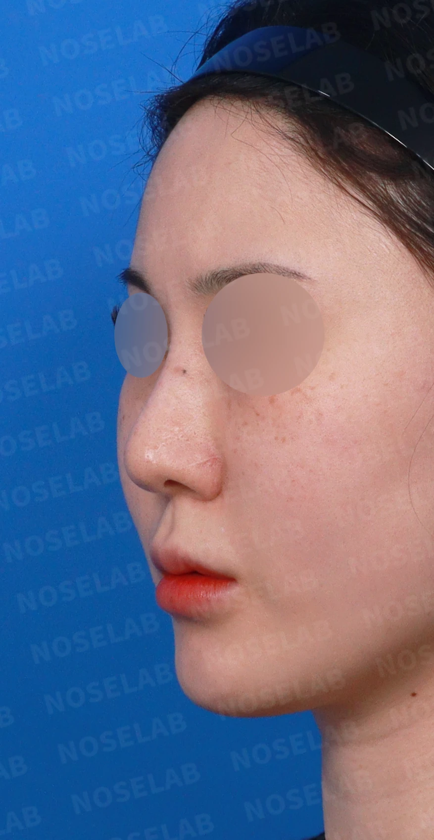 길고 뭉툭한 코, 자가늑연골로 화려하면서 자연스럽게 — 디자인 상담 정면, 좌측 측면, 비스듬한 측면 사진입니다.