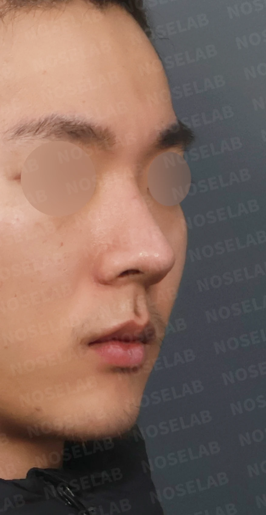 짧고 들린 코, 자가늑연골로 남성적인 라인으로 완성한 코재수술 — 디자인 상담 우측 비스듬한 측면, 측면, 비공 사진입니다.