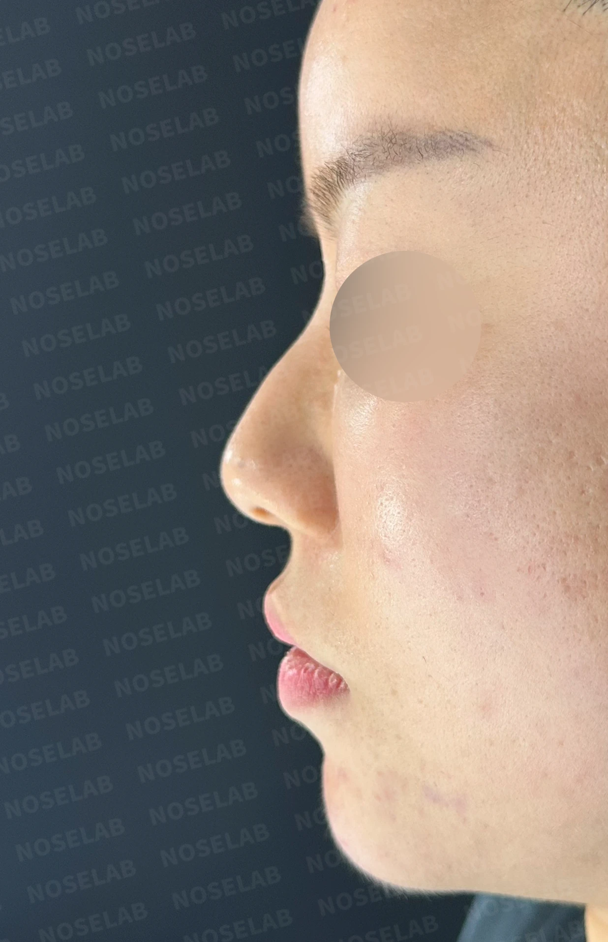 녹지 않고 남은 코 필러와 넓은 콧날개, 원인과 제거·교정 방법 — 수술 전 / 수술 직후 0일 직후 사진은 부기가 있는 상태로 최종 결과와 다를 수 있습니다.