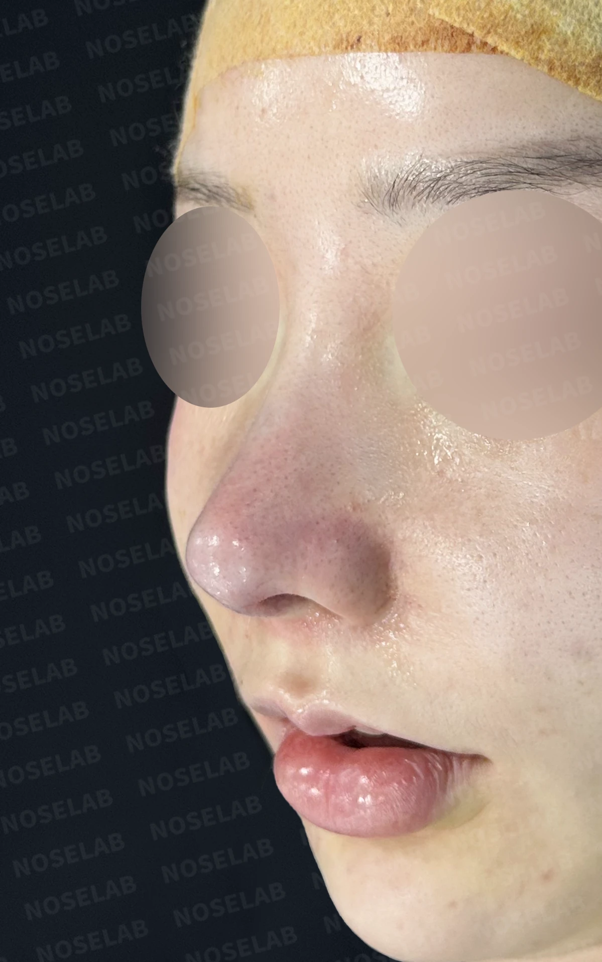 휘어진 코와 비공 비대칭, 자가늑연골 비중격 재건으로 완성한 코재수술 — 직후 정면, 비스듬한 측면, 측면 사진