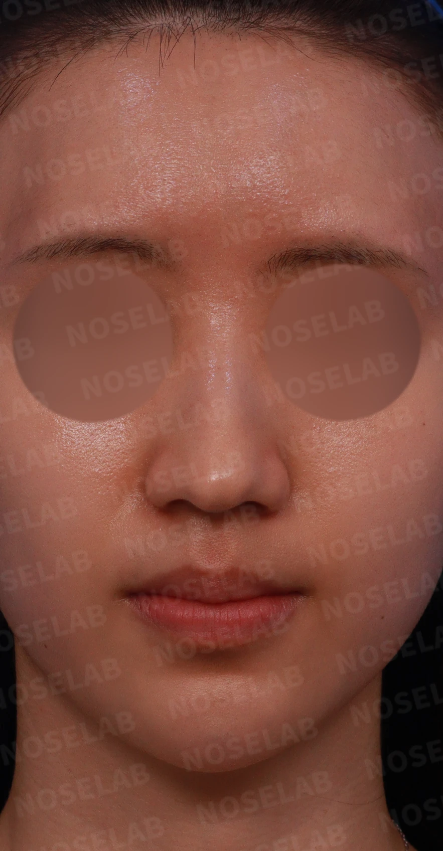 매부리코와 긴 코에 코막힘이 겹치는 이유, 교정은 어떻게 하나 — 디자인 상담 정면, 좌측 측면, 비스듬한 측면 사진입니다.