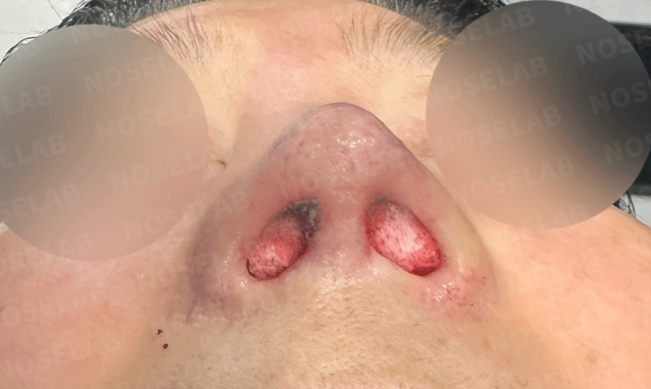 오래된 코 보형물과 코 통증, 재수술에서 확인할 점 — 본문 사진 14