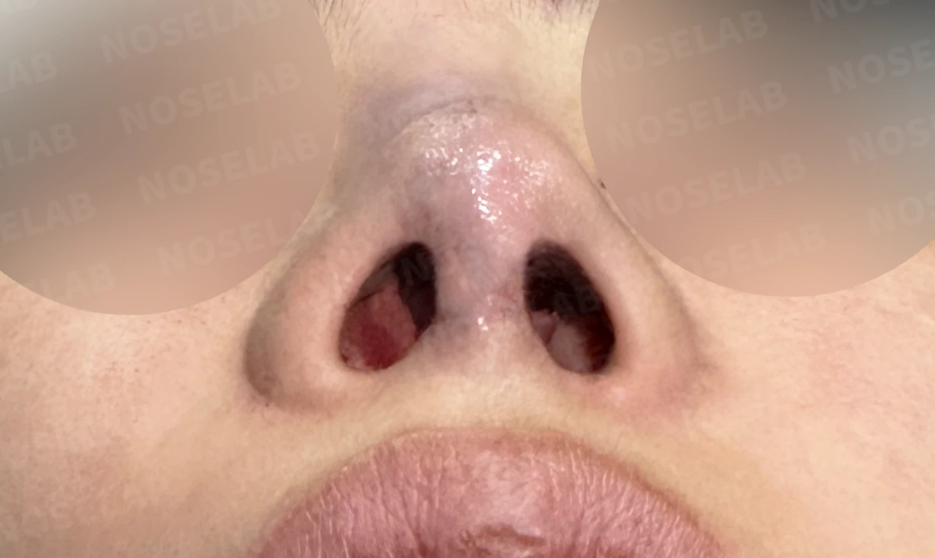 콧대에 주입한 불법 시술 이물질, 제거와 비중격 전체 재건은 어떻게 하나 — 수술 직후 0일 비공 사진입니다. 직후 사진은 부기가 있는 상태로 최종 결과와 다를 수 있습니다.