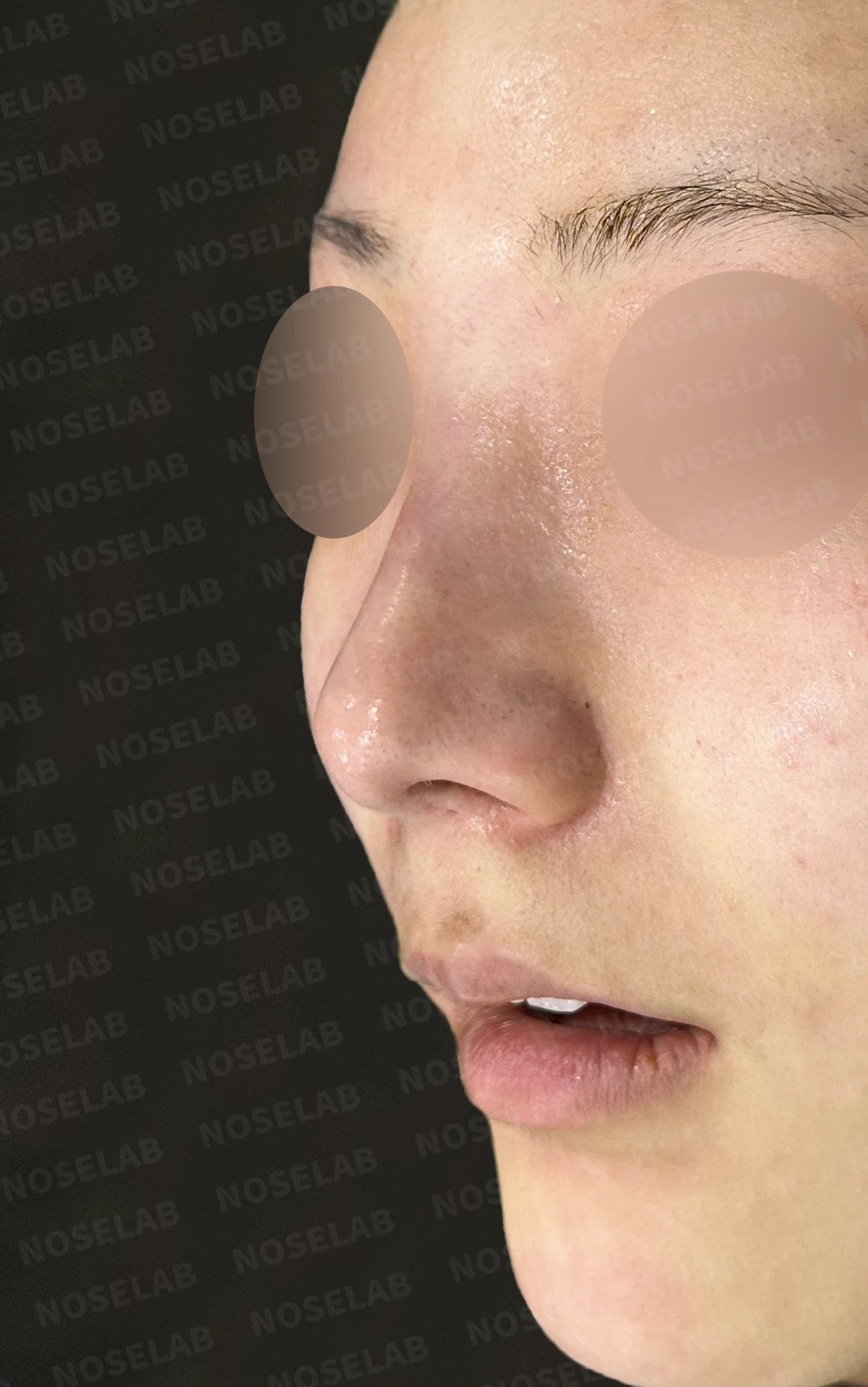 코필러 제거 후 자가늑연골 코성형, 처진 코끝과 메부리코를 자연스럽게 교정 — 직후 정면, 비스듬한 측면, 측면 사진입니다.