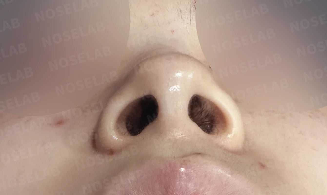 자가늑연골 코끝 성형과 매부리코·비순각 교정, 자연스럽고 화사한 코 라인 완성 — 전(좌) 직후(후)