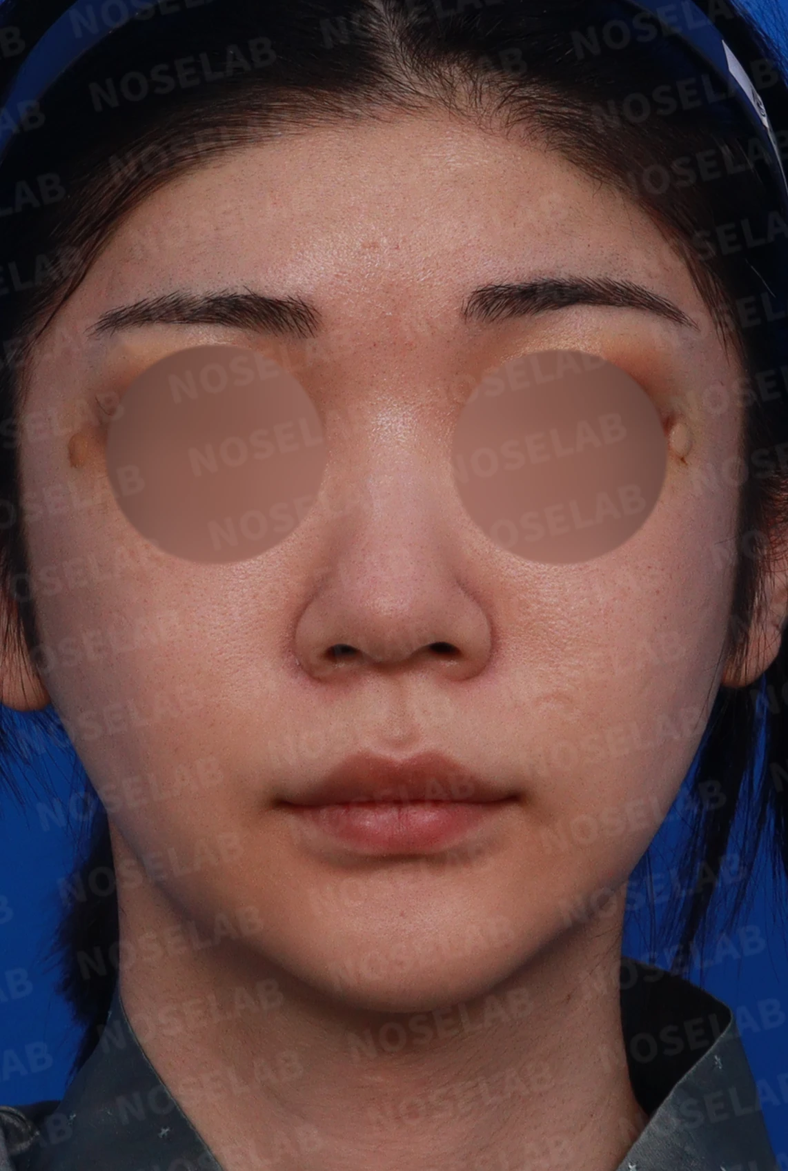 코가 뭉툭하고 퍼져 보이는 이유, 비순각과 비주는 어떻게 교정하나 — 디자인 상담 정면, 좌측 측면, 비스듬한 측면 사진
