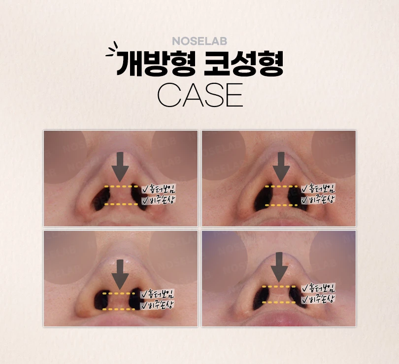 강차영원장의 고난도 코재수술 비개방코성형 수술 방법 — 본문 사진 5