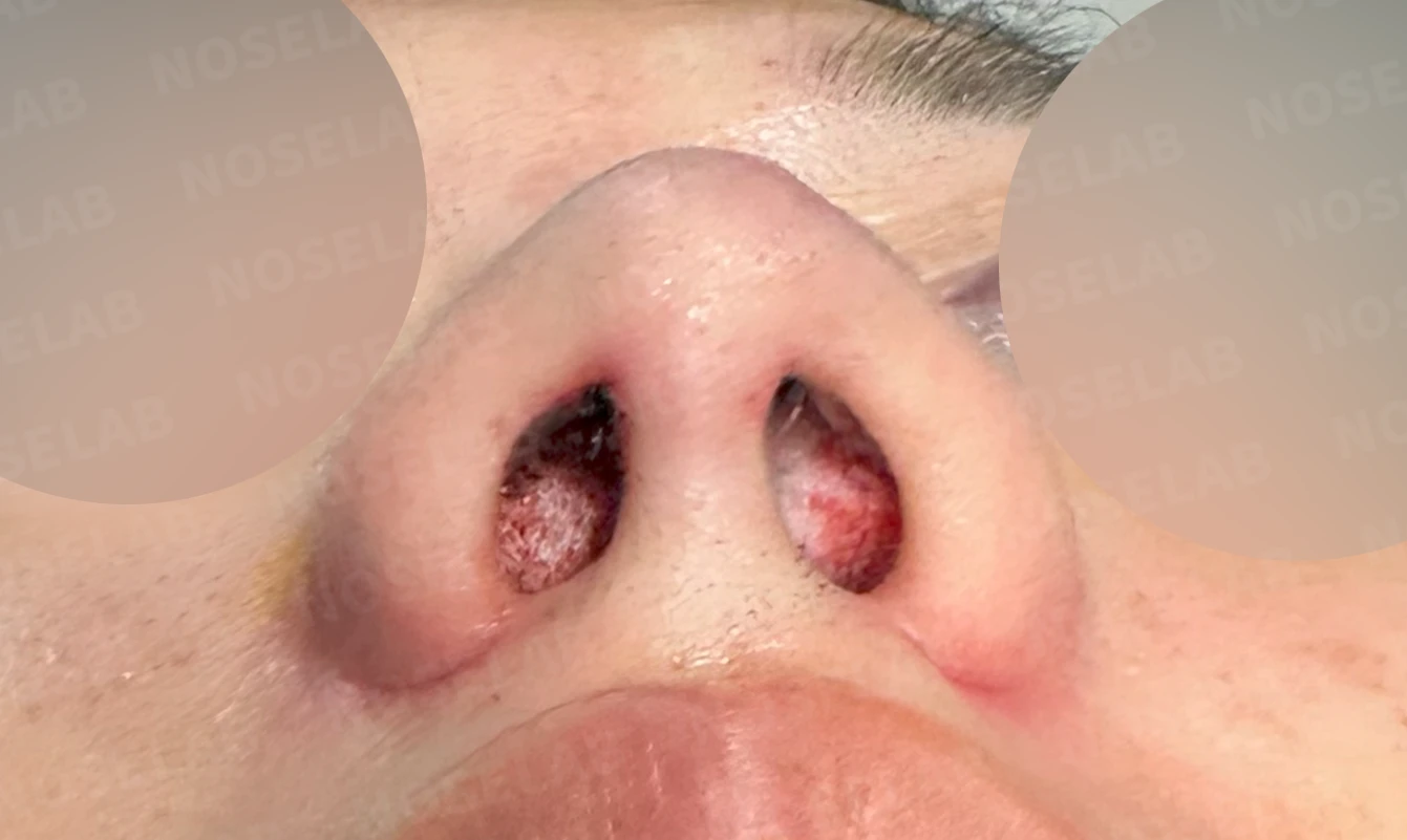 보형물 없이 코끝과 경계 부분만 교정하는 방법 — 수술 직후 0일 비공 사진 직후 사진은 부기가 있는 상태로 최종 결과와 다를 수 있습니다.
