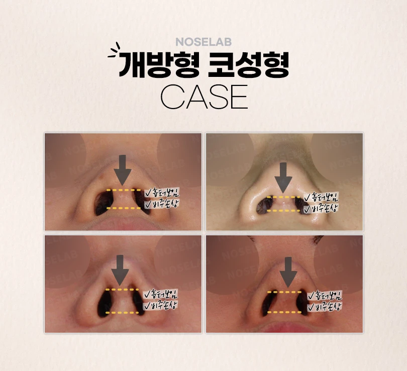 강차영원장의 고난도 코재수술 비개방코성형 수술 방법 — 본문 사진 6