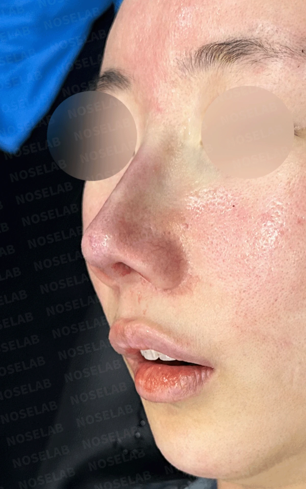 오래된 코 수술 뒤 비주가 함몰되고 코끝이 뭉툭해지는 이유와 재건 방법 — 본문 사진 12