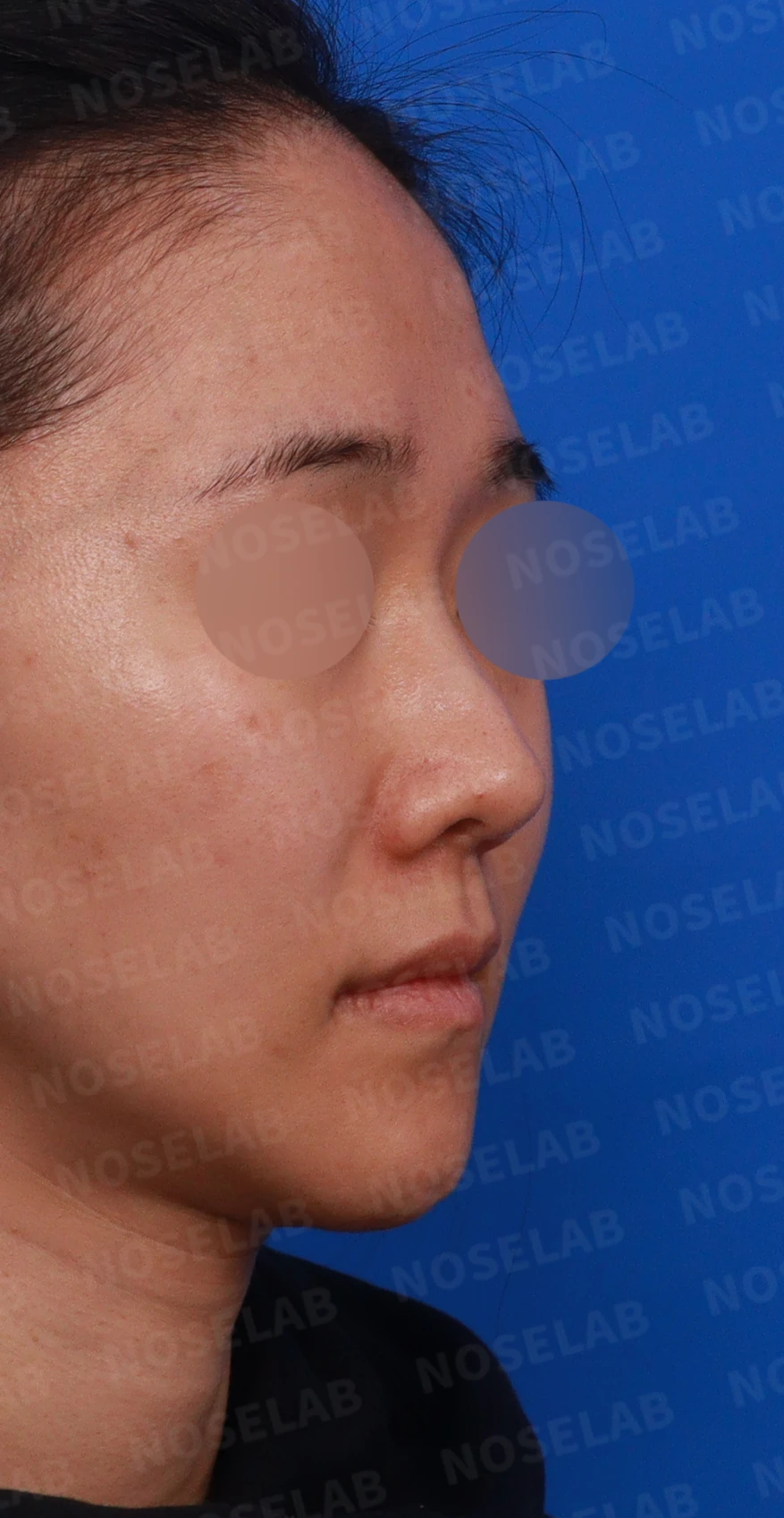 비중격 연골이 약해진 코, 보형물 없이 재건하는 방법 — 디자인 상담 우측 비스듬한 측면, 측면, 비공 사진
