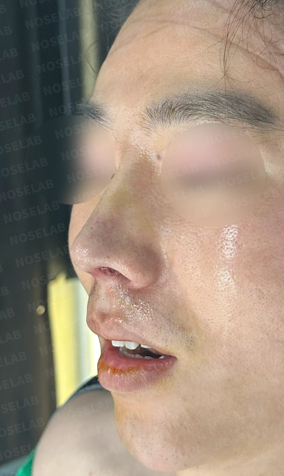코끝 염증을 겪은 뒤 콧날개가 찝히고 코끝이 꺼지는 이유와 재건 방법 — 수술 전 / 수술 직후 0일 직후 사진은 부기가 있는 상태로 최종 결과와 다를 수 있습니다.