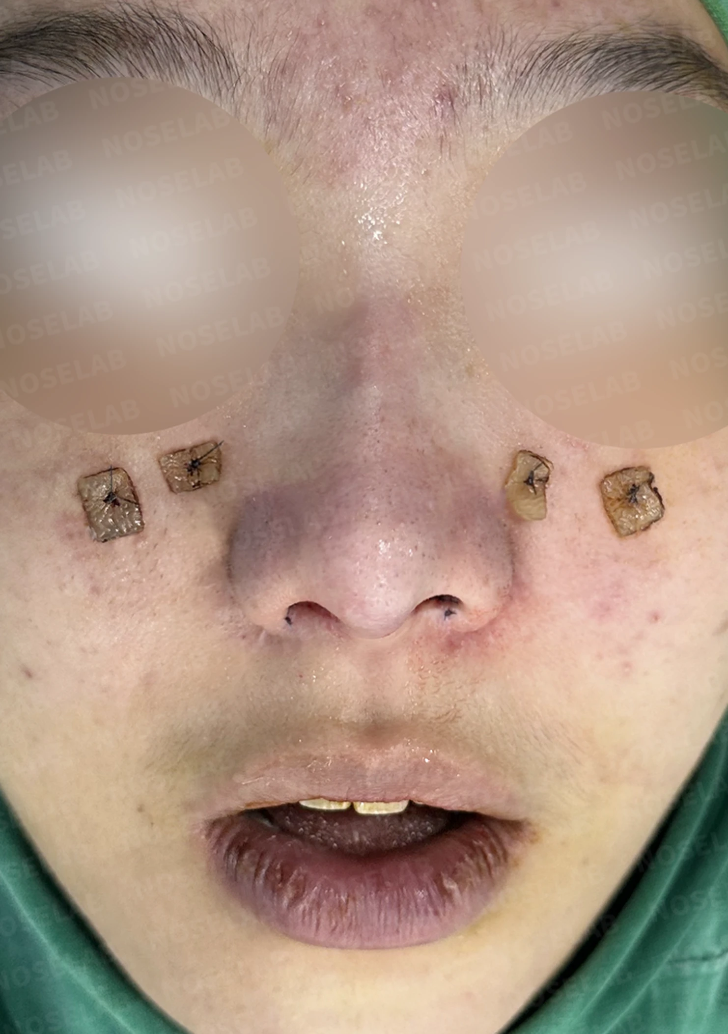 메드포어로 손상된 비중격, 자가늑연골로 완벽하게 재건하다 — 수술직후 정면, 비스듬한 측면, 측면 사진입니다.