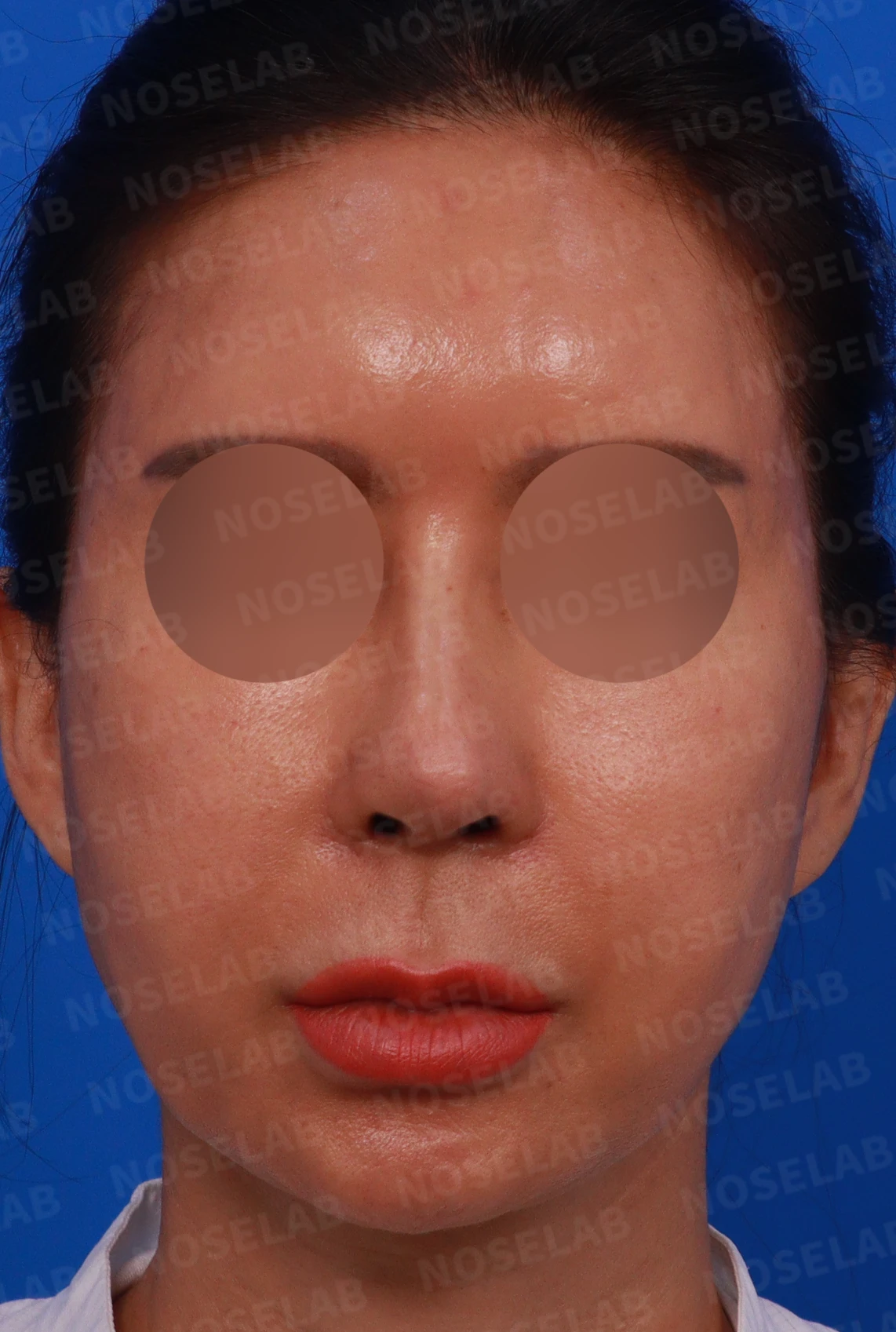 휜코와 뭉툭한 코끝, 콧구멍 비대칭의 비개방 교정 방법 — 수술전 디자인 상담 정면, 좌측 비스듬한 측면, 좌측 측면