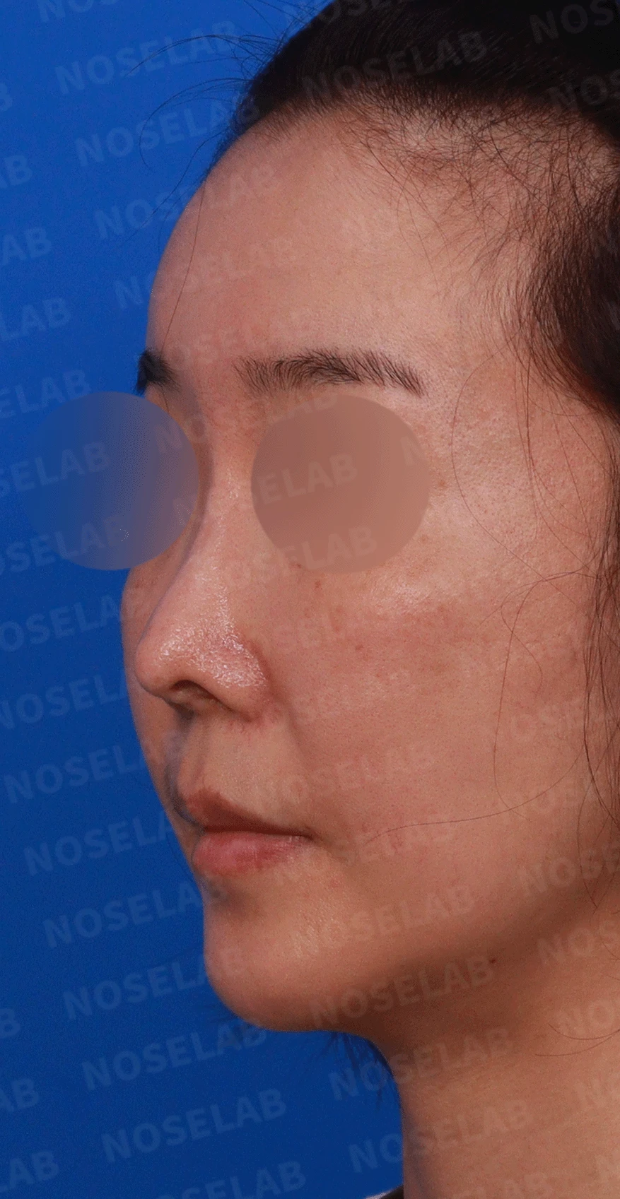 반복된 코재수술 뒤 안장코와 비밸브 협착이 생기는 이유, 전체 재건은 어떻게 하나 — 수술전 디자인 상담 정면 , 좌측 비스듬한 측면 , 측면 사진입니다.