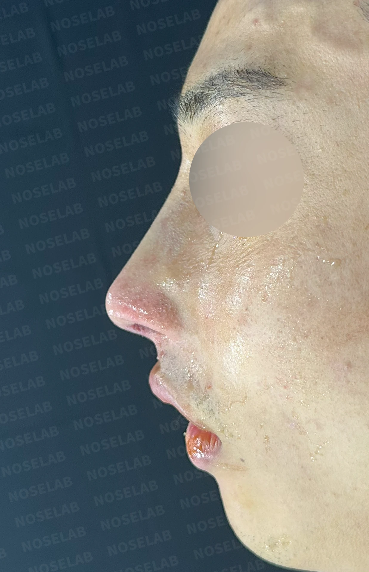 비염 수술 뒤에도 증상이 재발하는 이유, 휜 코를 함께 교정하는 방법 — 수술 전 / 수술 직후 0일 직후 사진은 부기가 있는 상태로 최종 결과와 다를 수 있습니다.