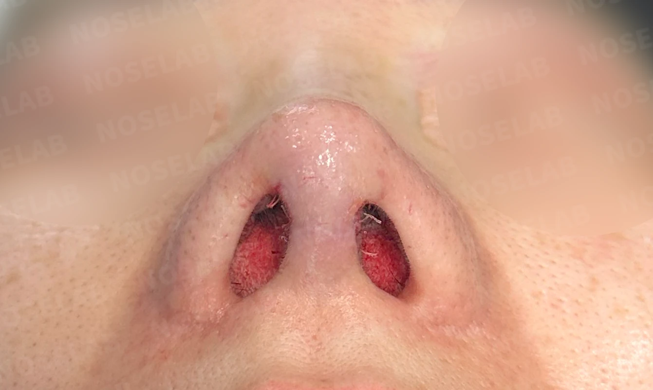 콧대 시작점이 높고 코가 휘어 보이는 이유, 자가 늑연골 교정은 어떻게 하나 — 수술 전 / 수술 직후 0일 직후 사진은 부기가 있는 상태로 최종 결과와 다를 수 있습니다.