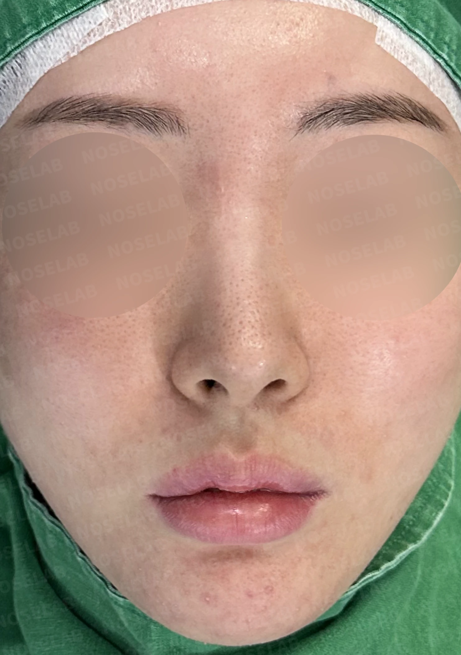 코가 길어 보이고 비주가 휘는 이유, 비중격 연장과 재건은 어떻게 하나 — 수술 전 / 수술 직후 0일 직후 사진은 부기가 있는 상태로 최종 결과와 다를 수 있습니다.