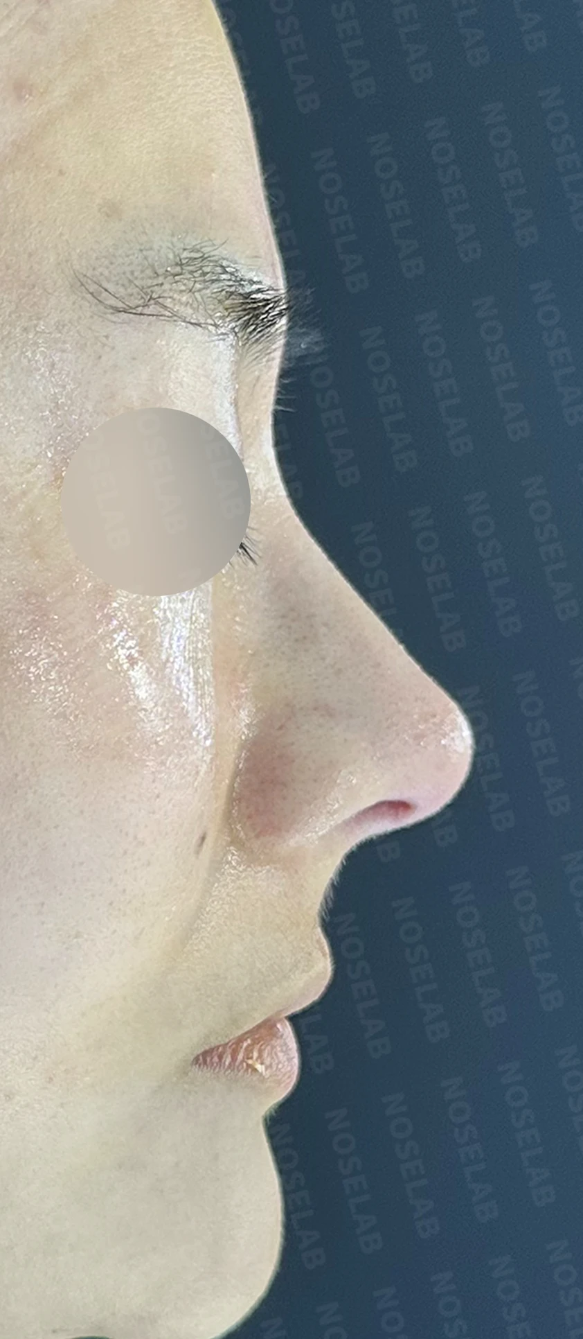 복코 수술은 어떻게 하나요? — 수술 직후 0일 사진들 90도 측면, 45도 측면, 정면 직후 사진은 부기가 있는 상태로 최종 결과와 다를 수 있습니다.