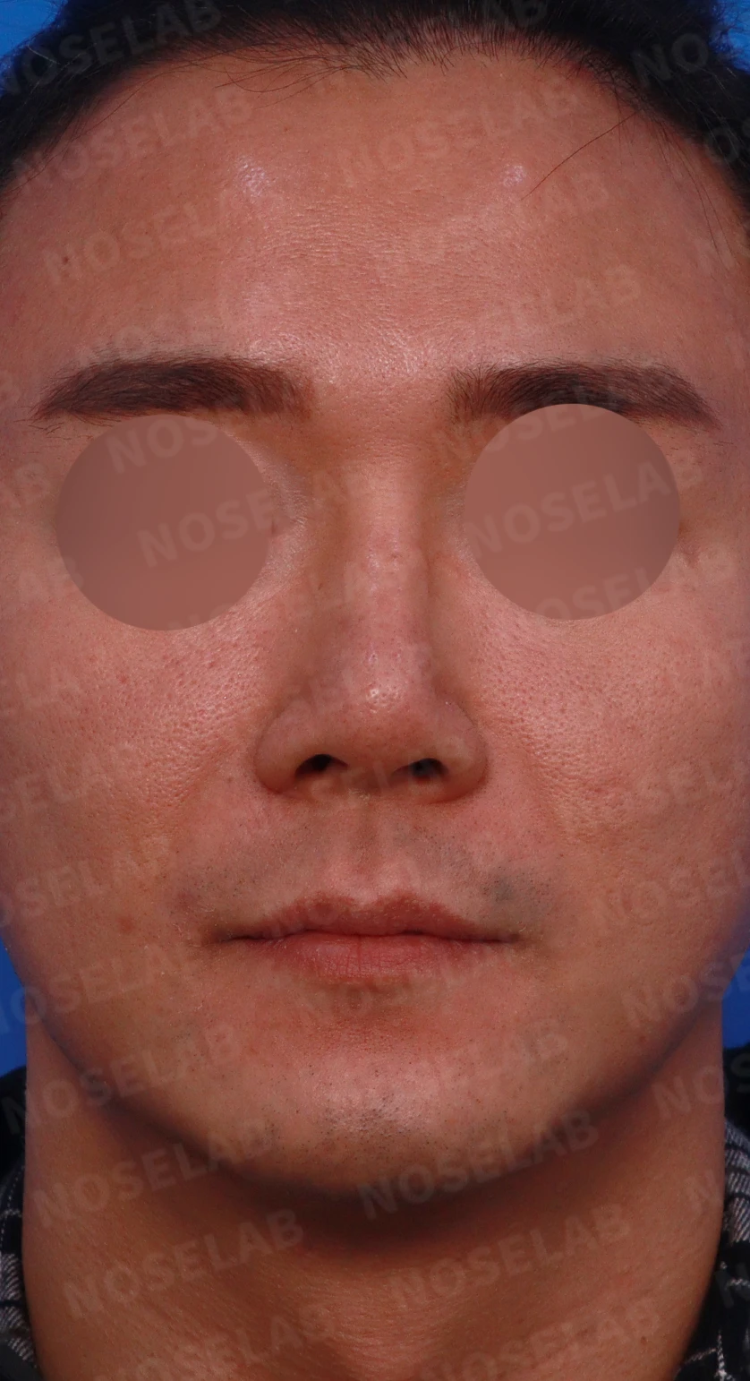 휜코와 코막힘, 코끝 구조를 함께 교정하는 방법 — 디자인 상담 정며, 좌측 측면, 비스듬한 측면 사진입니다.